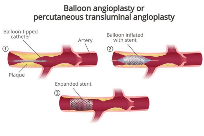 Patient undergoes percutaneous transluminal iliac artery balloon angioplasty