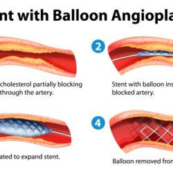 Angioplasty stents balloon procedure stent heart surgery illustration after blood cost clots arteries treatment viagra open disease inserted