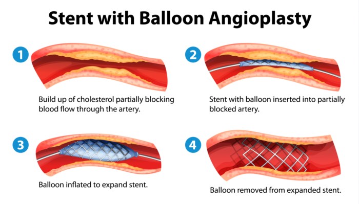 Angioplasty stents balloon procedure stent heart surgery illustration after blood cost clots arteries treatment viagra open disease inserted