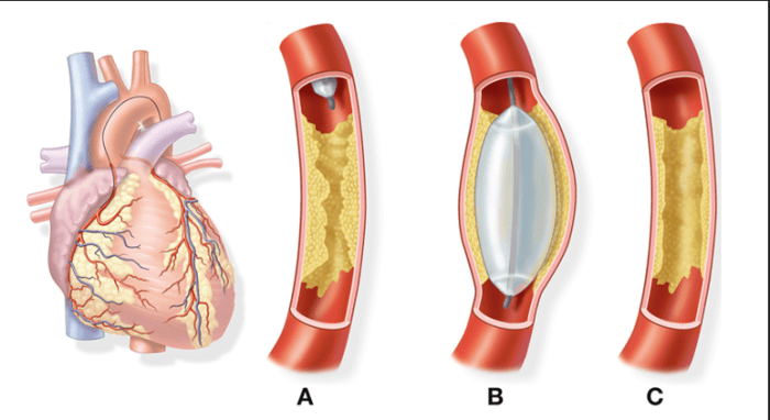 Patient undergoes percutaneous transluminal iliac artery balloon angioplasty